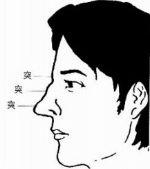 鼻梁起节