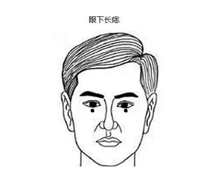 眼下长痣