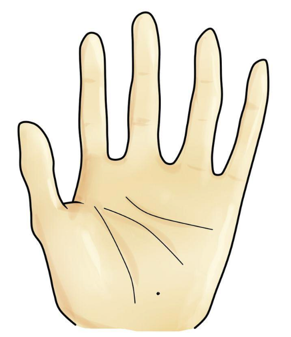 手指上的痣代表什么意思