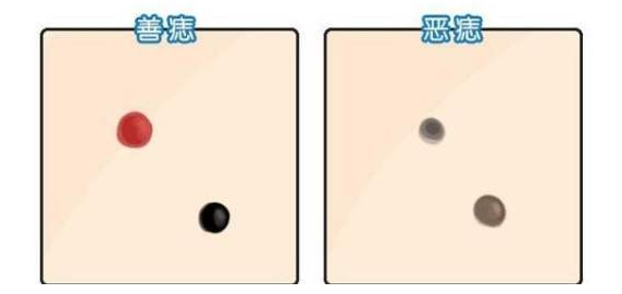 善痣和恶痣的区别