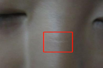 脸上有疤痕的人命好不好