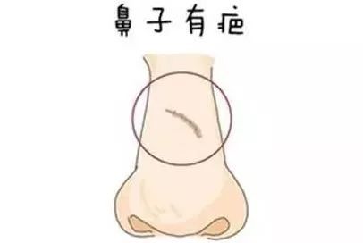 鼻梁有横纹